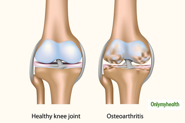 insideosteoarthritisPatient
