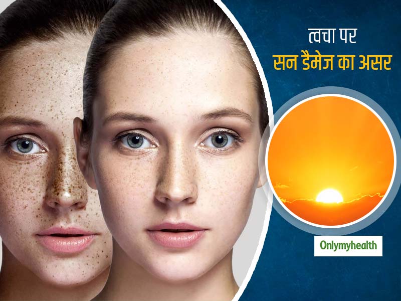 त्वचा का प्रकार तय करता है धूप से होने वाले नुकसान, जानें किसके चेहरे पर कैसा दिखता है 'सन डैमेज' का असर