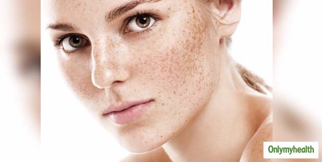 insidepatchesofpigmentation