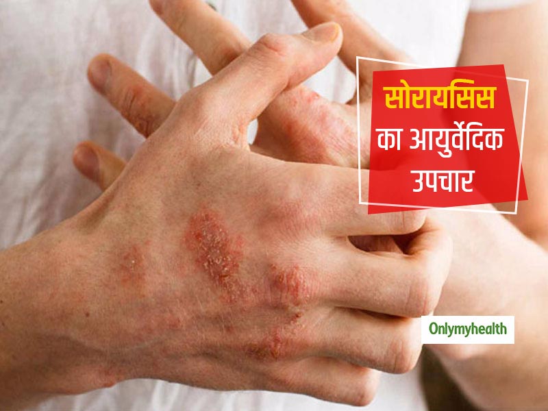 Skin Diseases: 6 प्रकार की होती है सोरायसिस की बीमारी, आयुर्वेदिक एक्‍सपर्ट से जानिए Psoriasis का पूरा इलाज