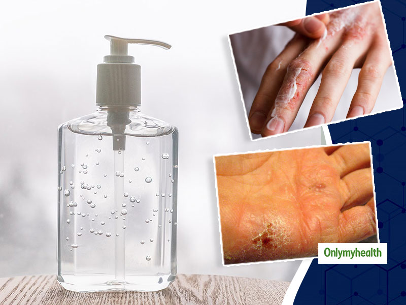 Dry, Cracked Skin On Hands And Knuckles? Here Are Some Tips And Tricks For Relief