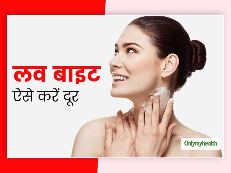 क्या लव बाइट या हिक्की के कारण आप भी हो जाते हैं शर्मिंदा? तो इन 4 घरेलू उपायों से पाएं हिक्की से छुटकारा