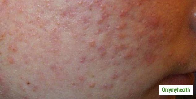 comedonal acne in hindi