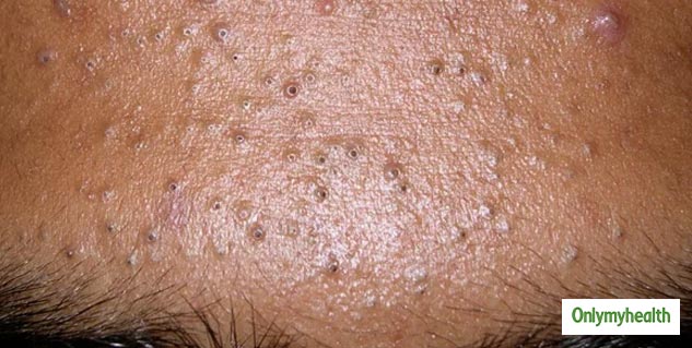 comedonal acne causes and treatment