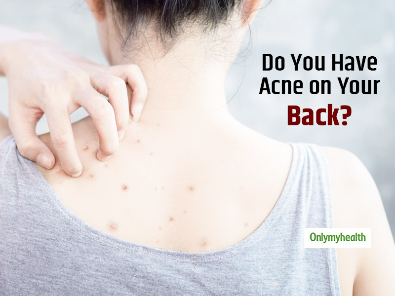Acne On The Back Is Common, Know Back Acne Causes, Treatment and Prevention Tips