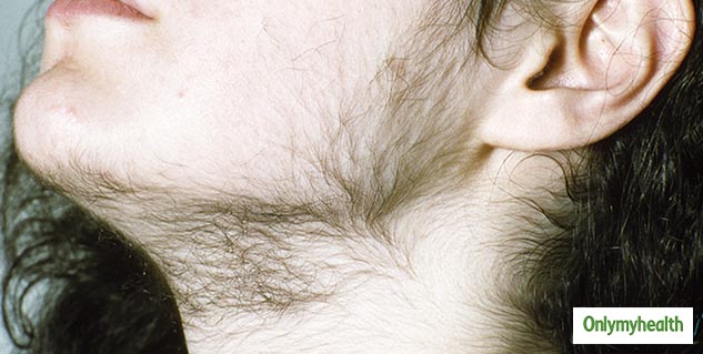 facial hair in female