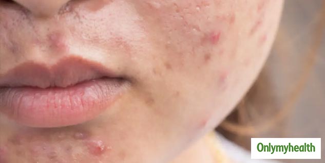 malaika arora acne free skin secrets