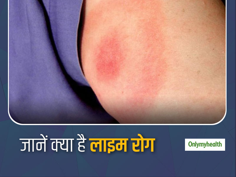 Lyme Disease: क्या है लाइम रोग, जानें किन कारणों से होता है ये रोग और क्या है इसके मुख्य लक्षण
