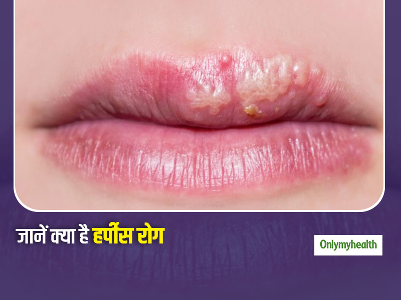 Herpes Diseases: क्या है हर्पीस रोग, जानें क्या है इसके कारण, लक्षण और बचाव
