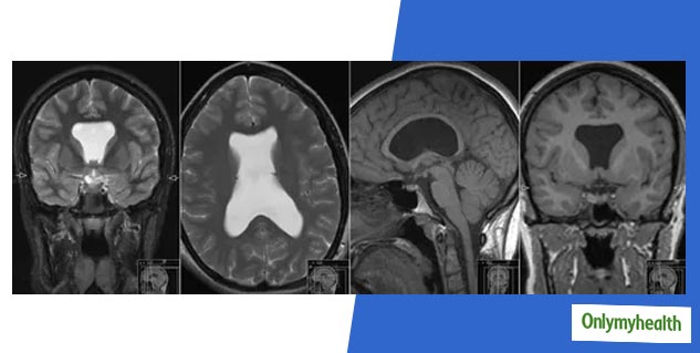 Treatment Of Absence Septum Pellucidum I