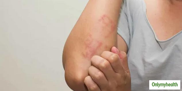 What Is The Causes Of Mushroom Allergy