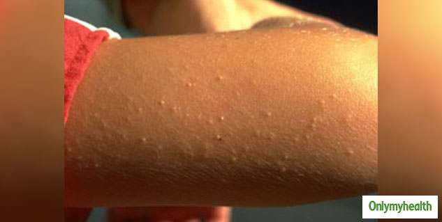 Keratosis Pilaris Causes