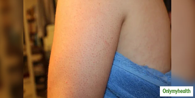Keratosis Pilaris Symptoms