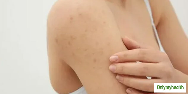 Keratosis Pilaris