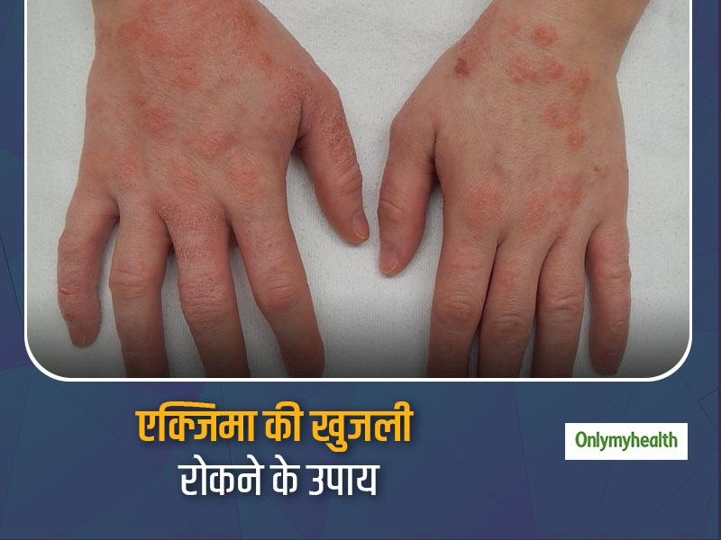 एक्जिमा की समस्या होने पर खुजलाने से फैल सकता है रोग, जानें किस तरह पाएं खुजली से राहत