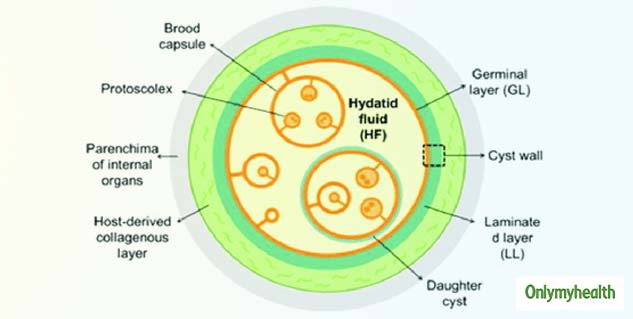 Hydatid Cyst Stages