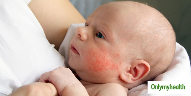 slapped cheek syndrome