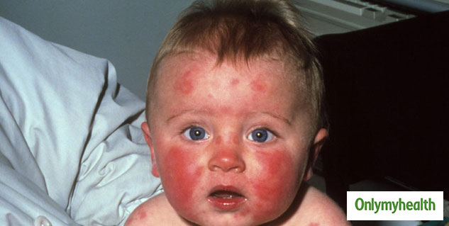 fifth disease in children