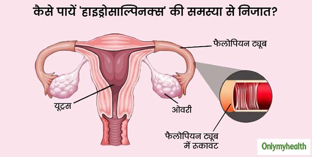 Fallopian-Tube-Blockage