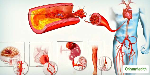 Atherosclerosis