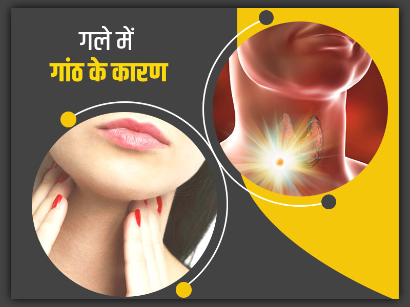निगलने में परेशानी और खराश जैसे लक्षण हो सकते हैं गले में गांठ का संकेत, जानें इसके कारण, लक्षण और इलाज