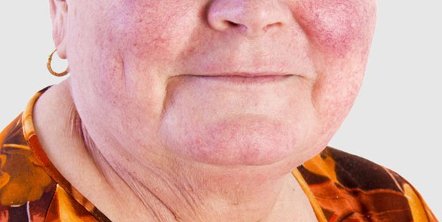 butterfly spot treatment