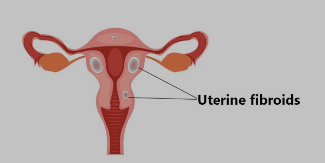 Inside4fibroids