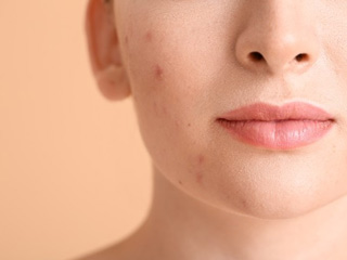 How To Get Rid Of Whiteheads In 10 Ways