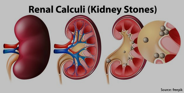 what-are-kidney-stones