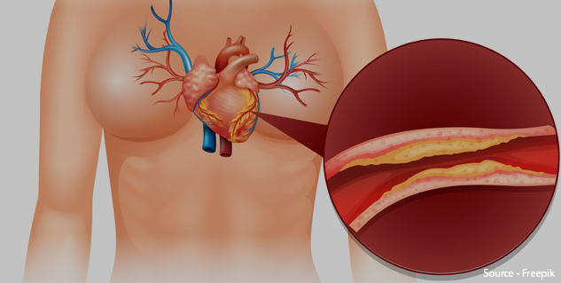 Blood-Clotting-in-Heart-Surgery