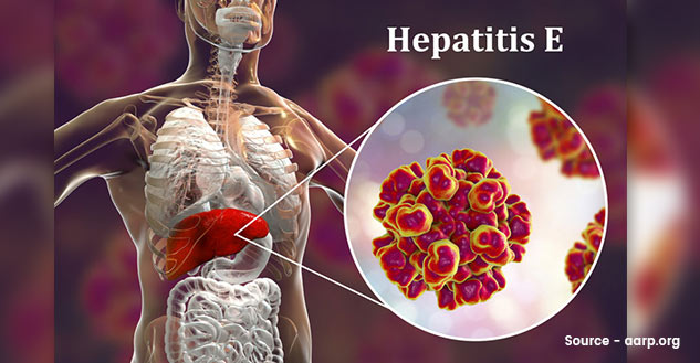 hepatitis E