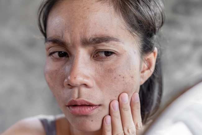 Dry Skin