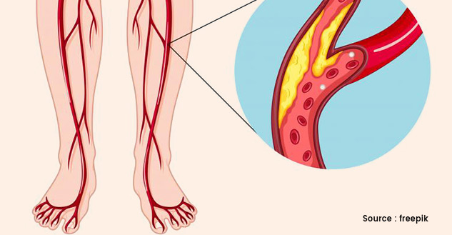 Claudication-Causes-Symptoms-Treatment