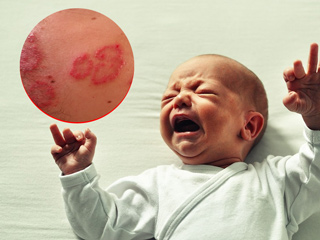 शिशु या बच्चों में होने वाली खाज की समस्या दूर करने के 8 असरदार घरेलू उपाय