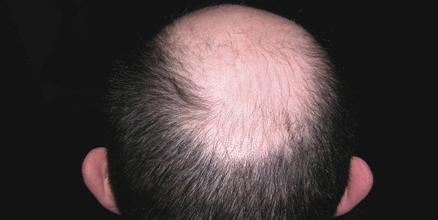baldness in men