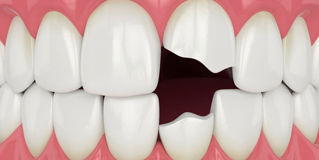Broken teeth Treatment