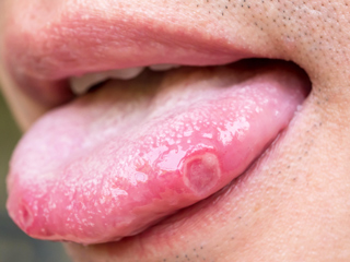 मुंह के अंदर घाव और छाले हो सकते हैं 'कैंकर सोर' का संकेत, जानें इसके लक्षण और घरेलू उपाय