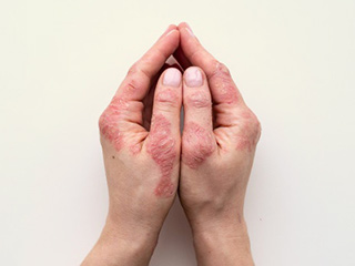 10 Home Remedies To Treat Psoriasis