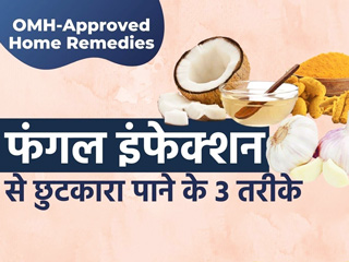 OMH Approved: फंगल इंफेक्शन से छुटकारा पाने के लिए 3 आसान घरेलू नुस्खे