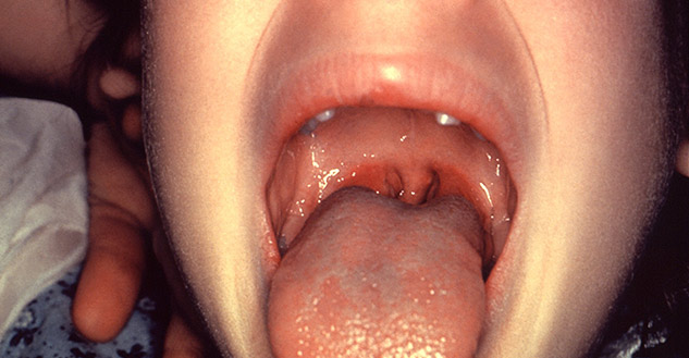 sore throat in kids