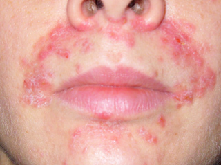 मुंह के आसपास रैशेज (पेरियोरल डर्मेटाइटिस) को दूर करने के लिए 8 घरेलू उपाय