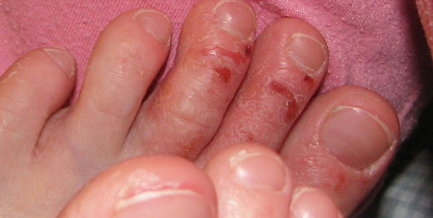 how-to-use-tea-tree-Oil-for-skin