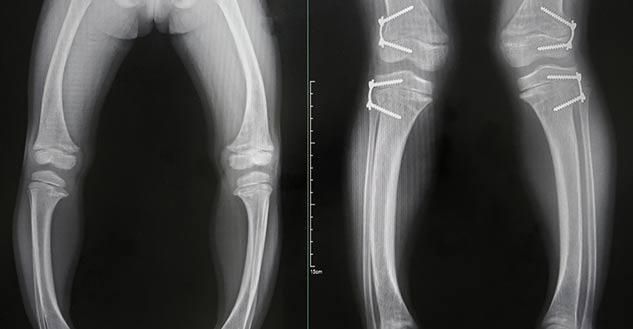 sukha-rog-rickets-in-children-causes-symptoms