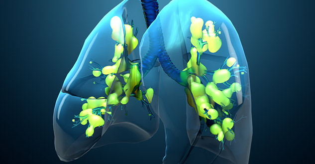 Acute-Respiratory-Distress-Syndrome