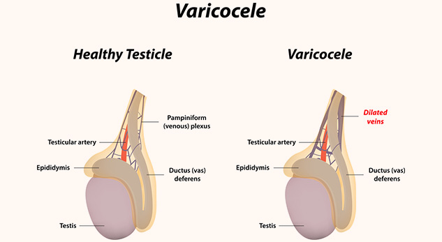 Varicocele Symptoms