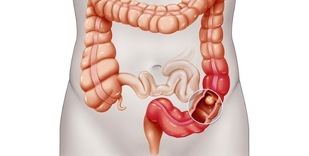 inside2Intestinaltb