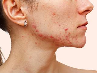 हॉर्मोन्स के कारण चेहरे पर हो गए हैं मुहांसे? इन 9 घरेलू उपायों से पाएं हॉर्मोनल एक्ने से छुटकारा