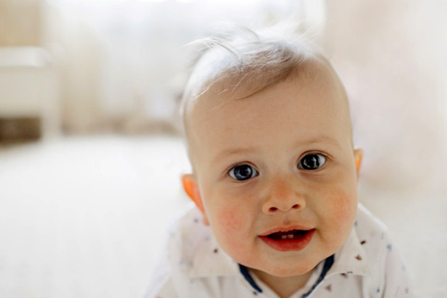 Skin infection in babies