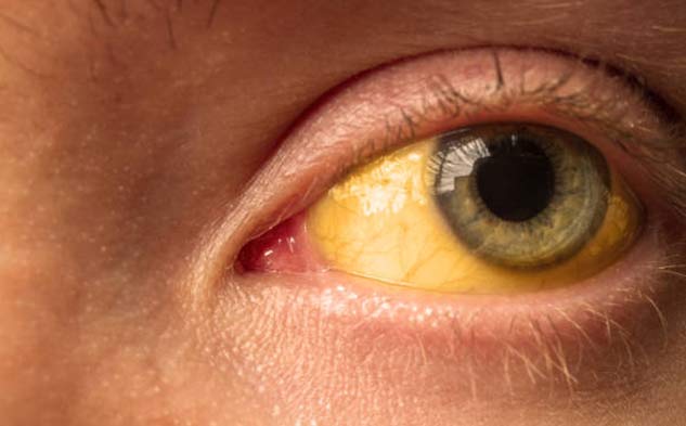 Jaundice-Myths-Facts