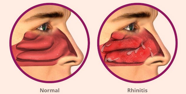 Non-Allergic Rhinitis Vs Allergic Rhinitis